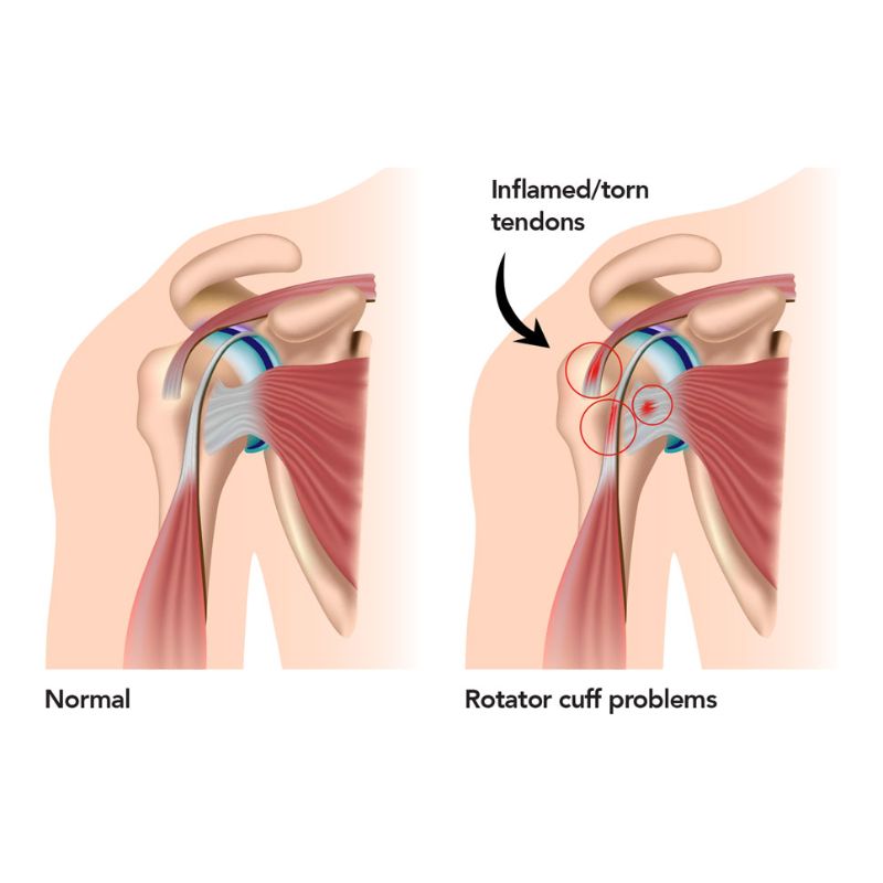 Feeling The Pinch? The Stubborn Shoulder Impingement Syndrome news item at Momentum Healthcare